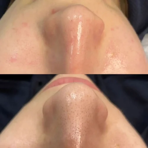 Before and after Hydro Facial 03