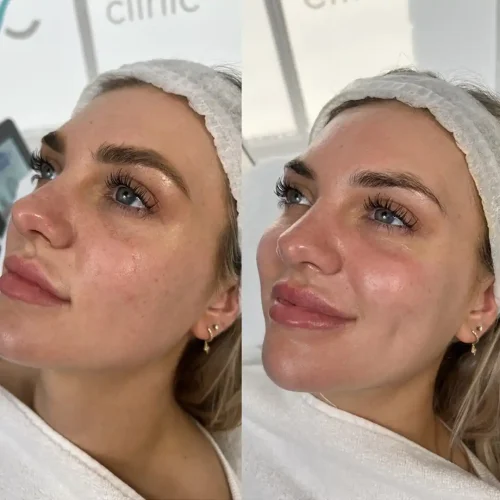 Before and After PureHydro 2