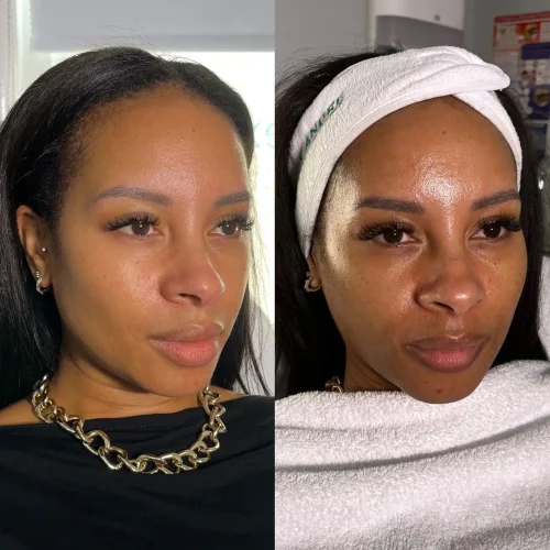 Hydro Facial Before and after 02
