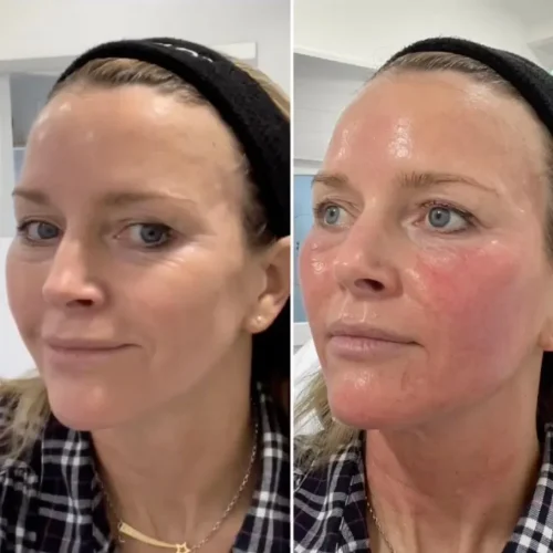 Amazing results after 3 sessions.